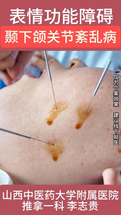 下颌关节紊乱针灸治疗
