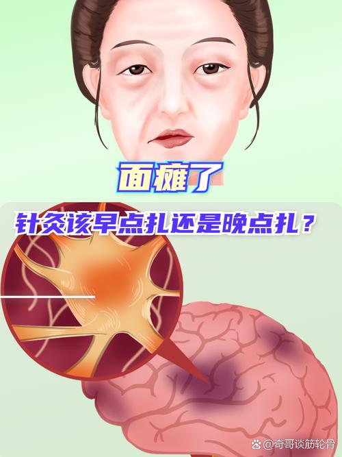 面瘫 针灸 恶心 晕