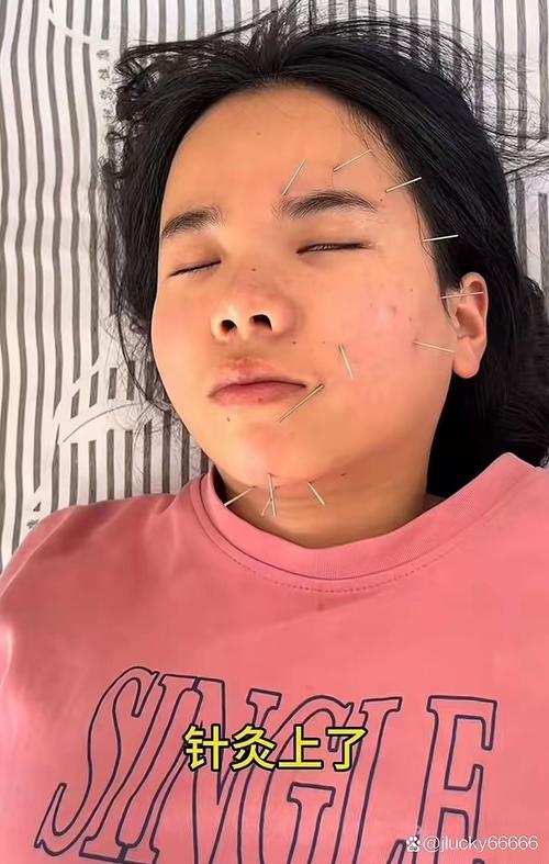 面瘫 针灸 恶心 晕