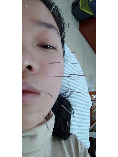 面瘫 针灸 恶心 晕