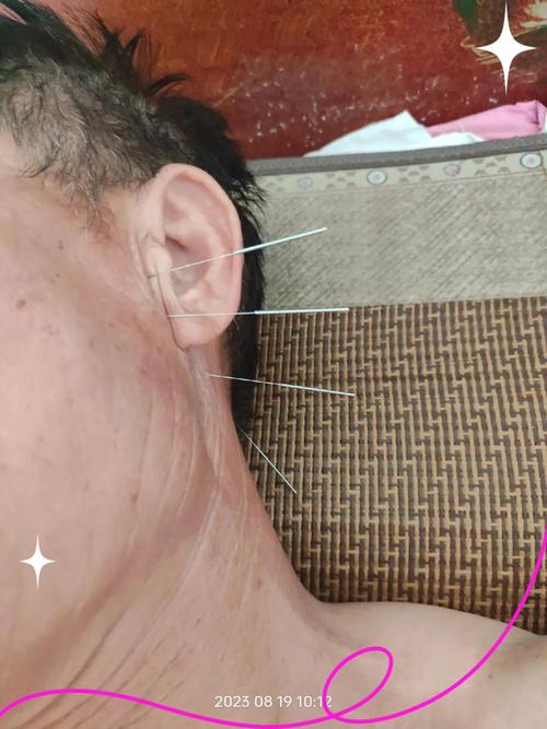 耳鸣针灸 多少钱一次