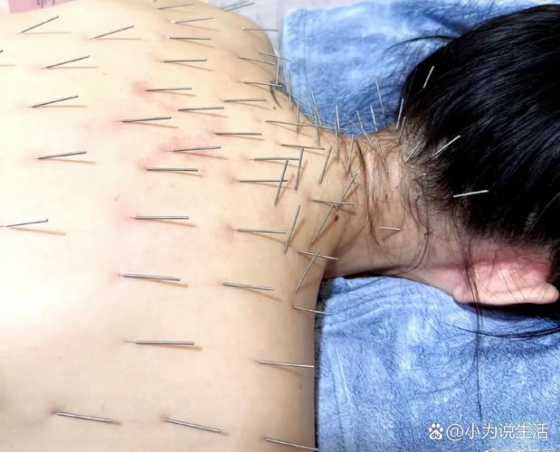 神经性皮炎 针灸放血