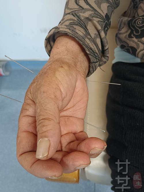 顽固性呃逆的针灸治疗