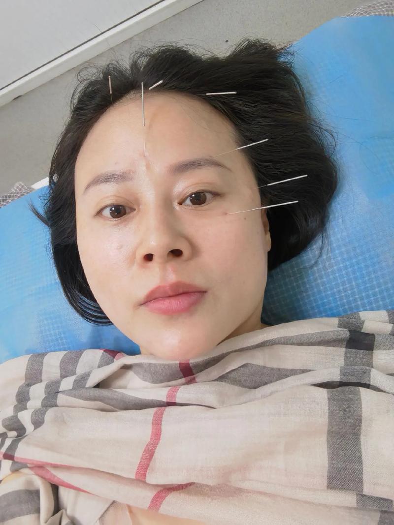 针灸怎么治疗眼肌无力