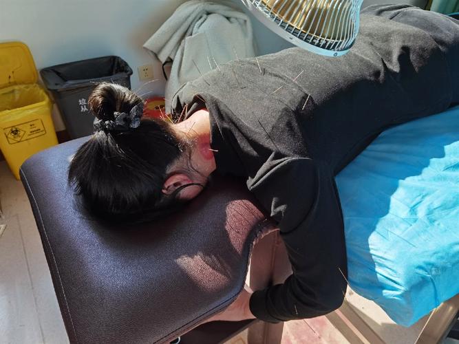 脊髓型颈椎病针灸治疗