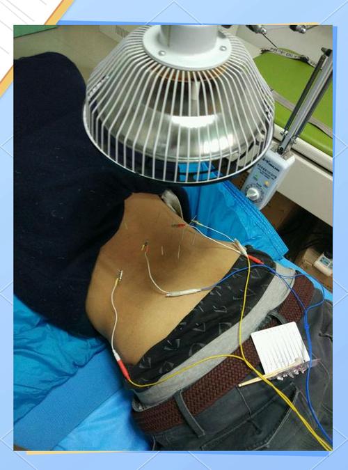 针灸直接腰椎间盘突出