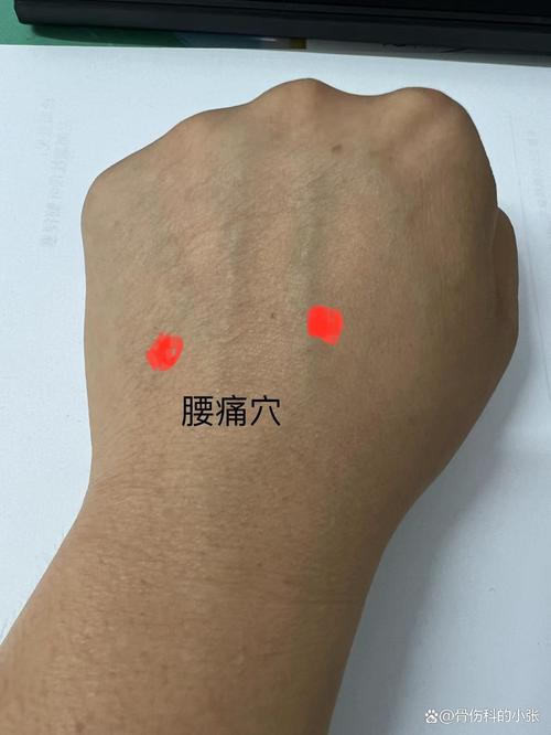 急性腰扭伤的针灸穴位