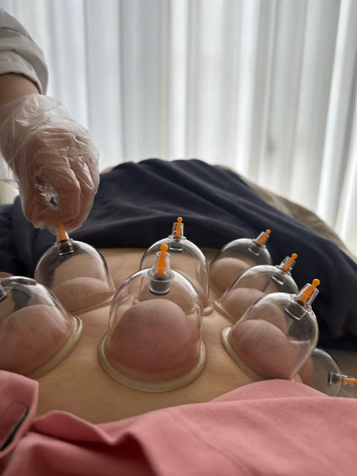 厦门中医院 针灸减肥