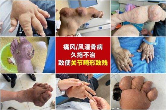 成都哪家医院医痛风好