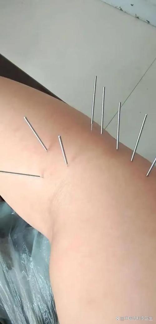 急性腰扭伤的针灸治疗