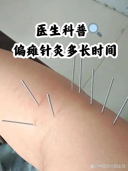 针灸对中风的治疗方法