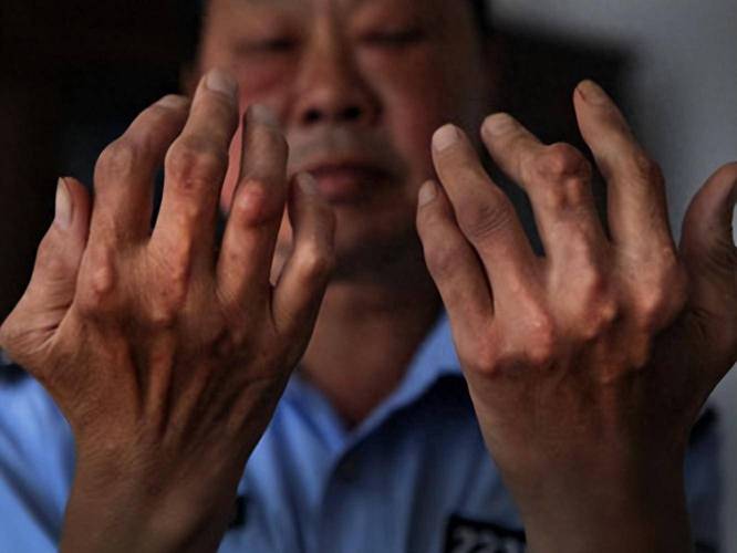 鸡精对痛风患者的影响