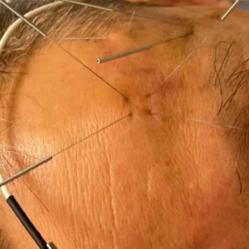 针灸 面瘫 有效果吗