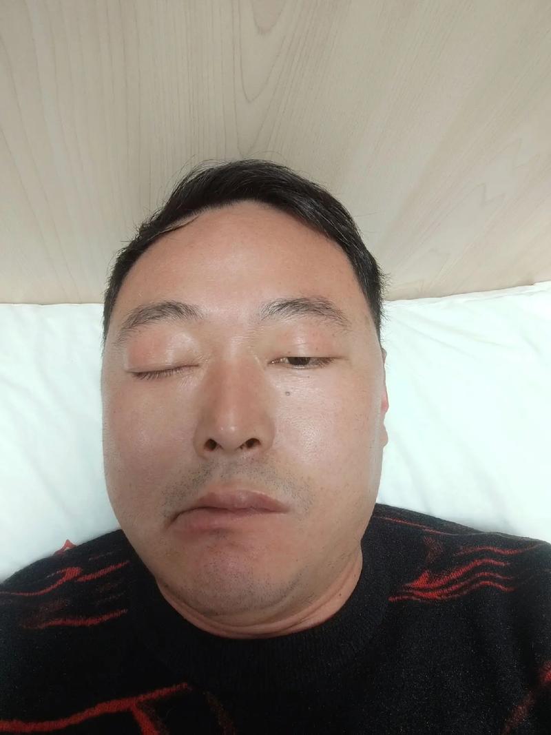 面瘫针灸一个月没效果