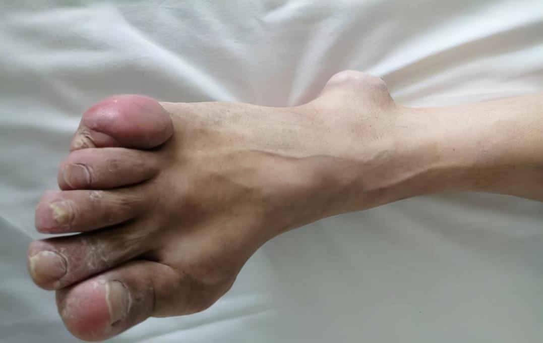 痛风慢性期有什么症状