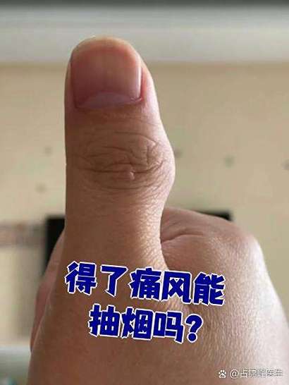 抽烟对痛风有什么影响