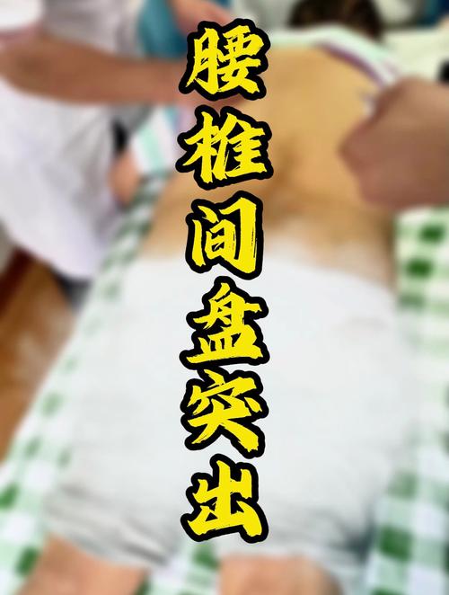 腰间盘突出急性期针灸