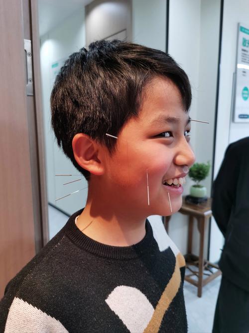 脑供血不足可以针灸吗