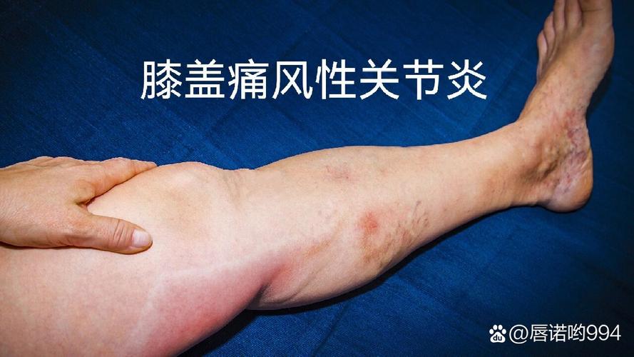 痛风导致膝盖痛的症状