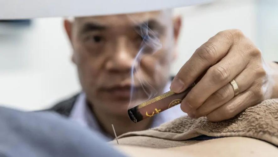 新西兰针灸一次多少钱