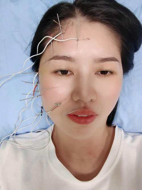 面瘫能直接挂针灸科吗