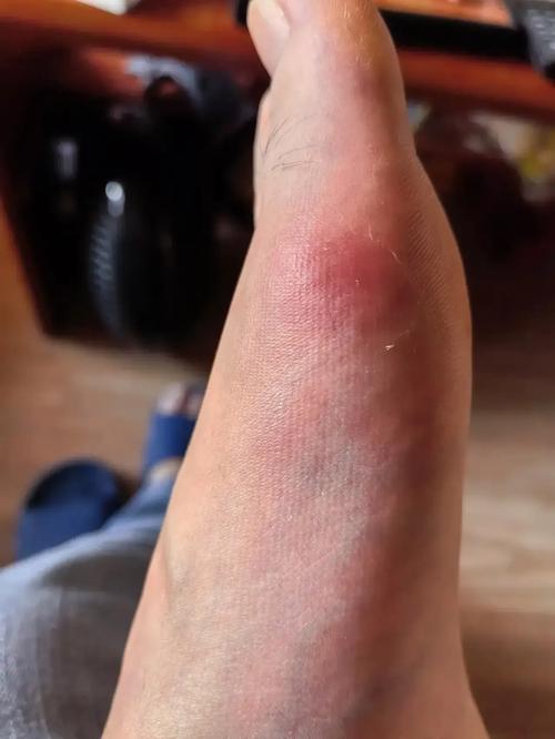 痛风发作尿酸才485