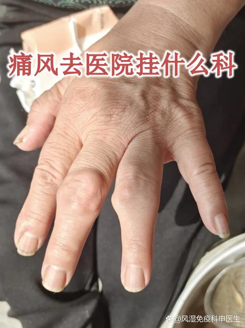 痛风挂号应该挂什么科