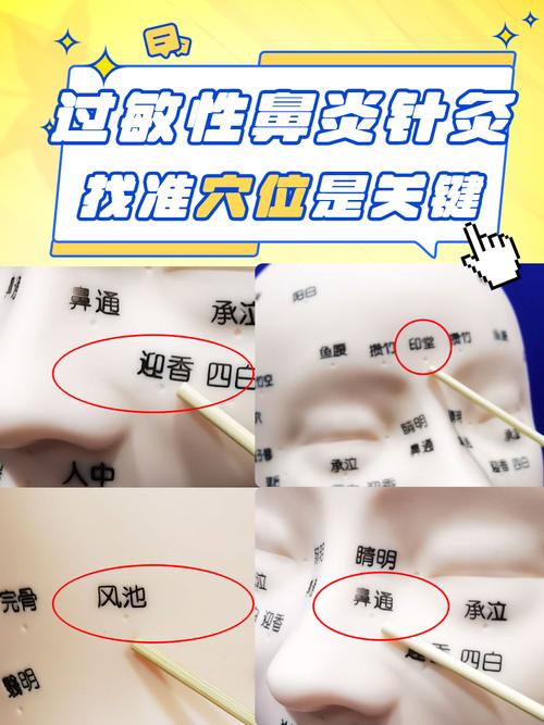 浙江省中医院针灸鼻炎