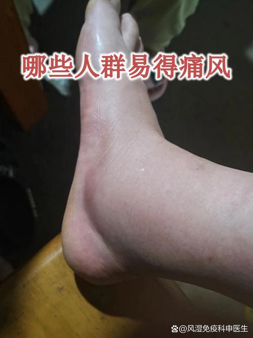 盘锦哪家医院能治痛风