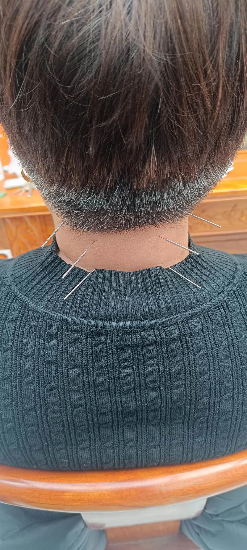 艾针灸治疗腺样体肥大