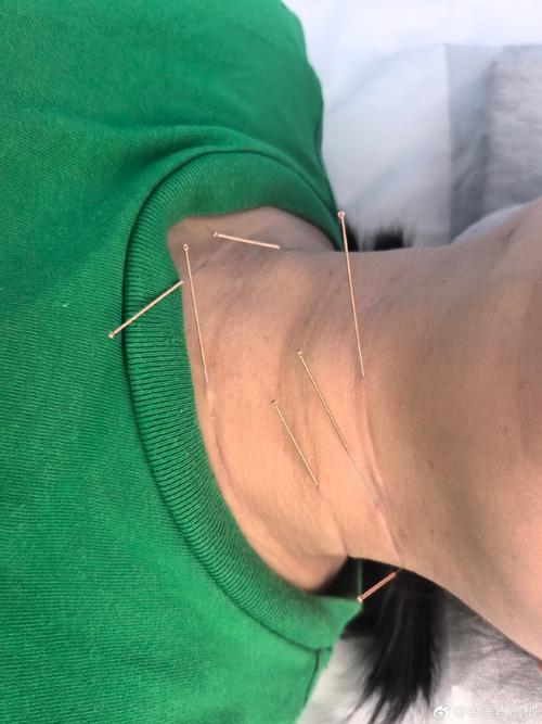 艾针灸治疗腺样体肥大