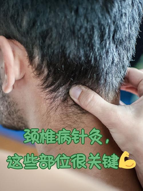 孕妇可以针灸治颈椎病