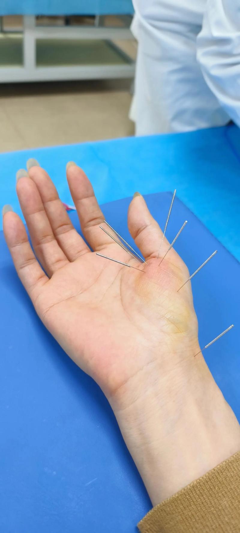 拇指腱鞘炎的针灸治疗