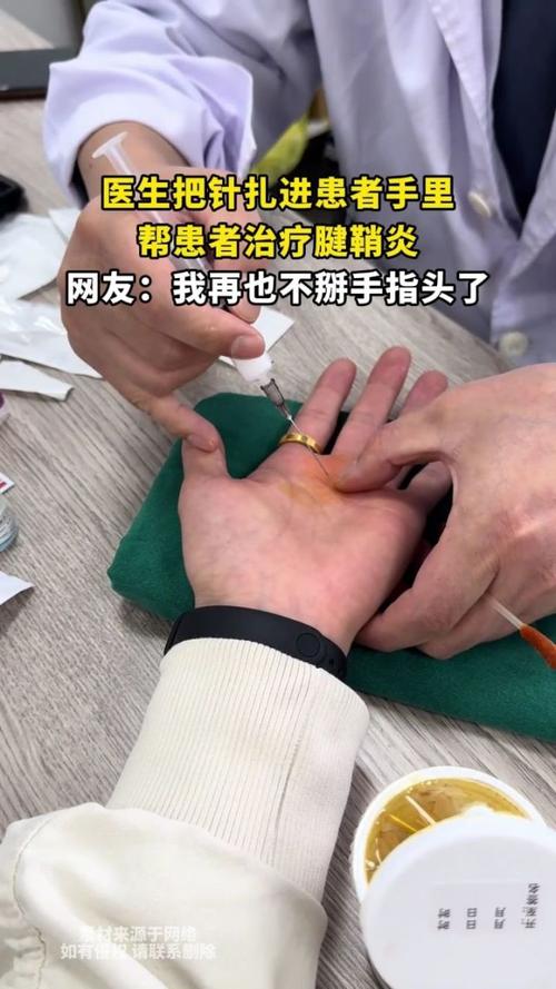 拇指腱鞘炎的针灸治疗