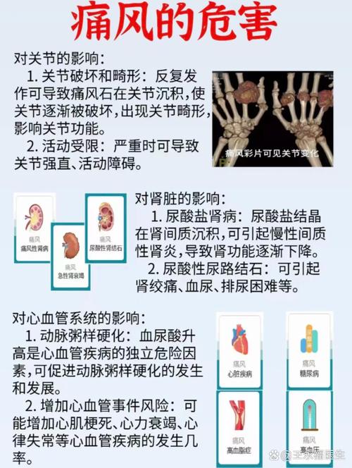 痛风会对肾有什么影响
