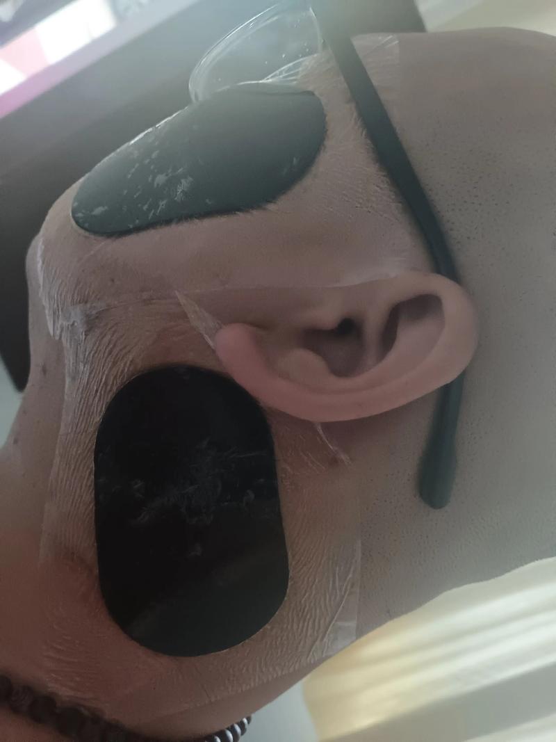 面瘫贴膏药还能针灸吗