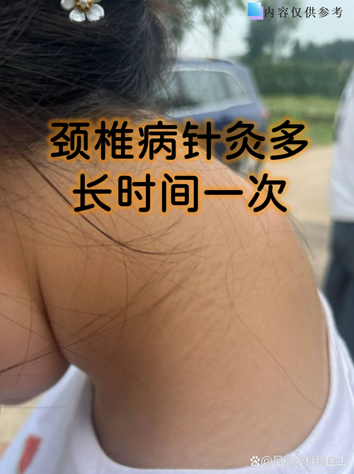 颈椎反弓针灸有效果吗