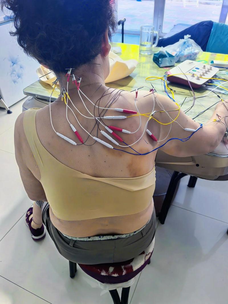 颈椎反弓针灸有效果吗