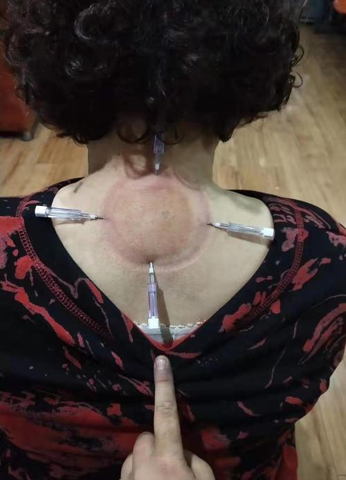 富贵包针灸可以消除吗