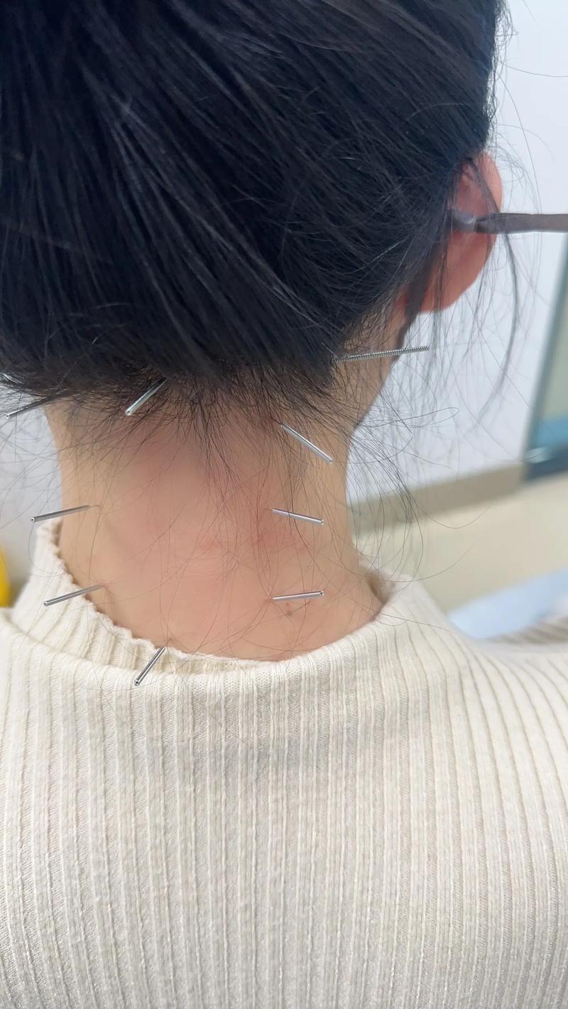 苏州市立医院北区针灸