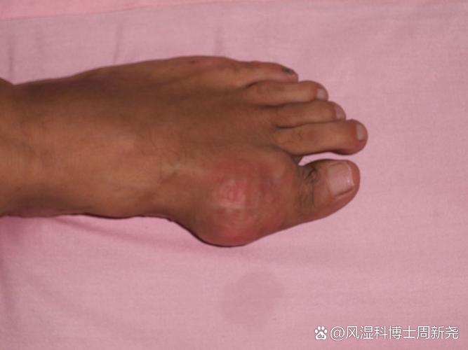 27岁痛风尿酸500