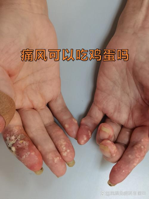 痛风患者多吃鸡蛋好吗