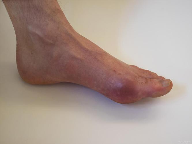 患了痛风会有什么症状