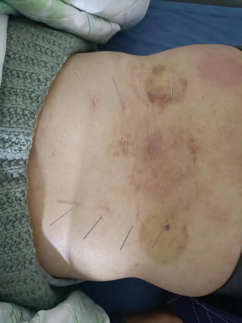 移植前针灸几次效果好