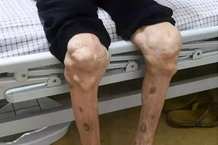 痛风晚期症状图片大全