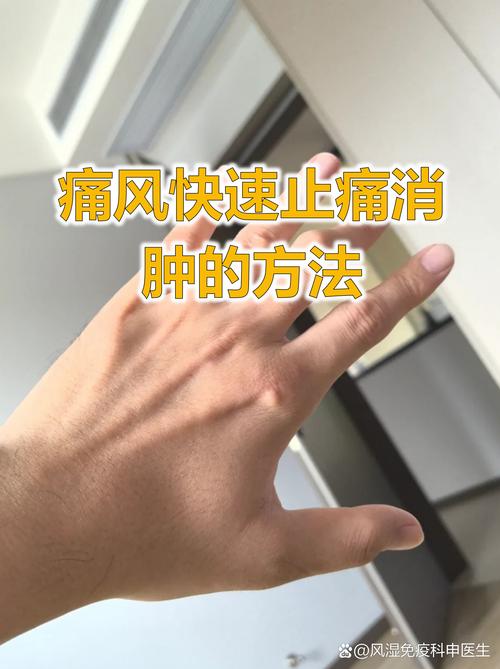 快速c反应蛋白 痛风