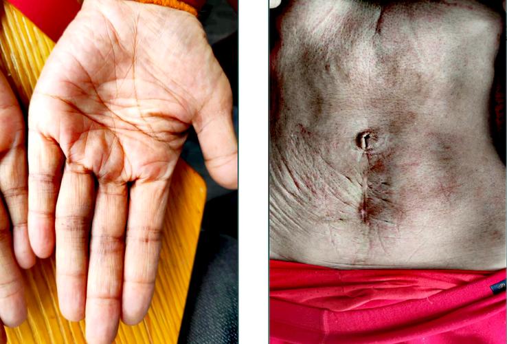 针灸6天乳腺结节没了