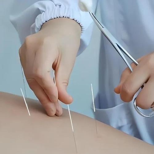 眩晕症可以针灸治疗吗