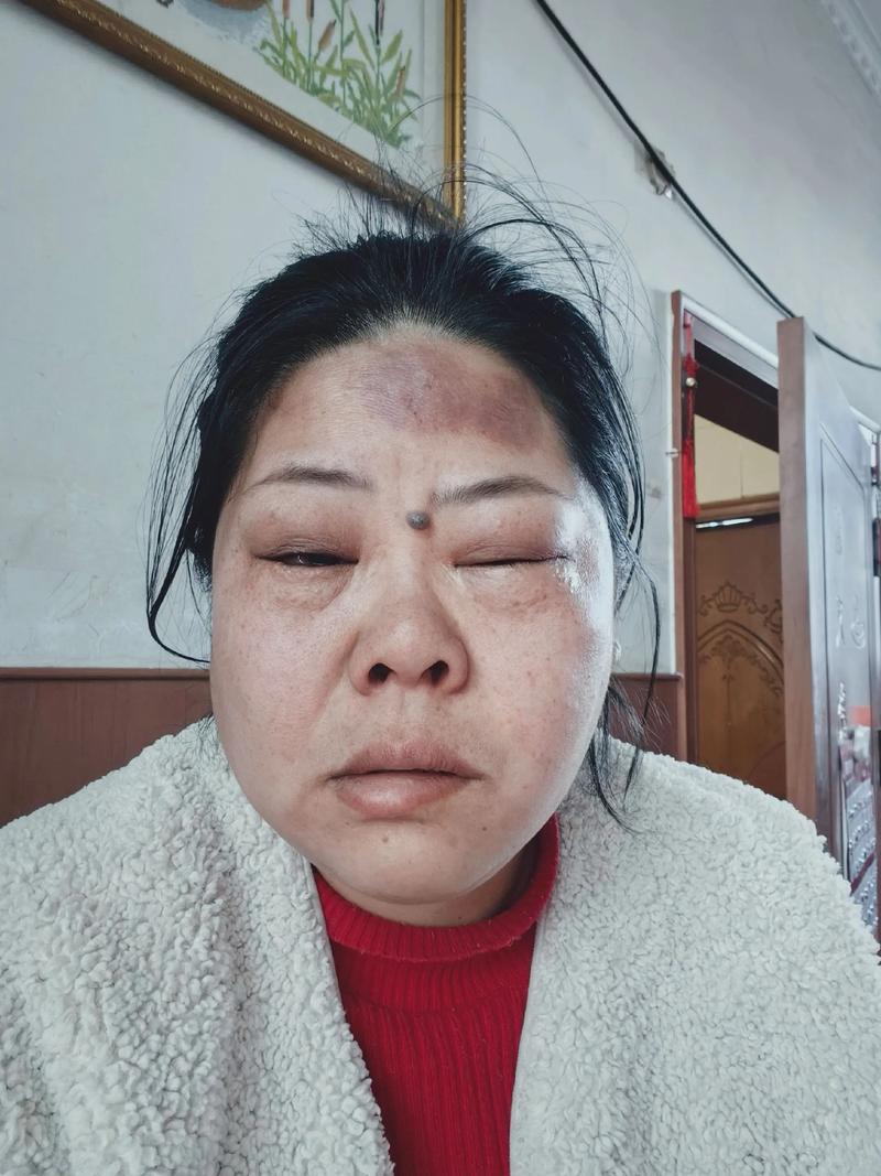 针灸会导致面部痉挛吗