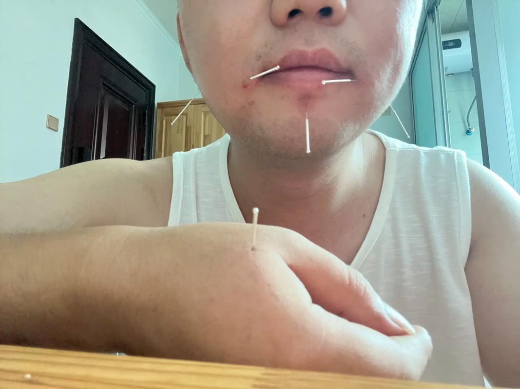 针灸会导致面部痉挛吗